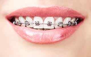 teeth aligners