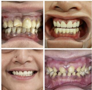 implants and veneers