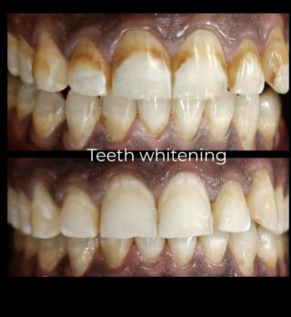 teeth whitening