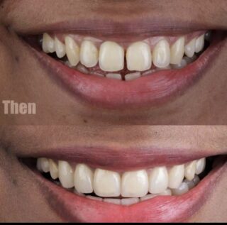 veneers