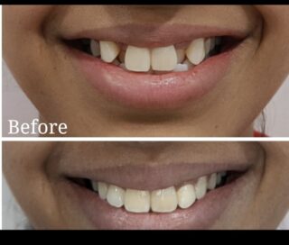 veneers