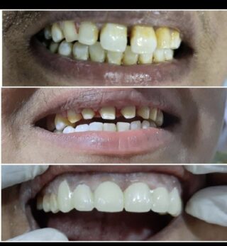 veneers