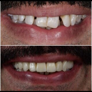 veneers