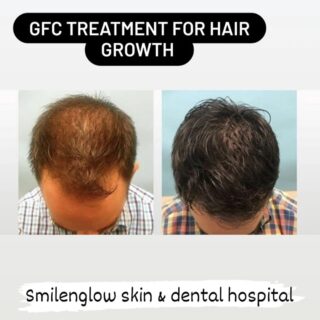 gfc treatment