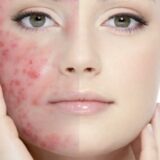 anti acne advancements